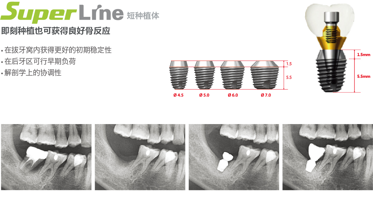 短種植體-45.jpg